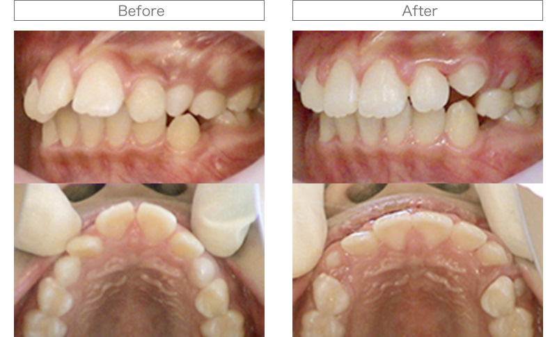 矯正歯科治療 Before/After写真