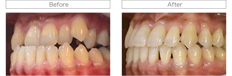 矯正歯科治療 Before/After写真