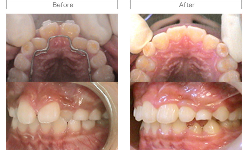 矯正歯科治療 Before/After写真