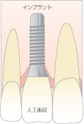 インプラント（人工歯根）