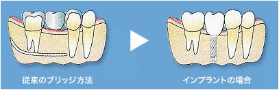 ブリッジとインプラントの比較