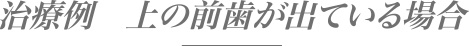 治療例　上の前歯が出ている場合